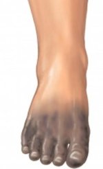 gangrene-of-foot7142.jpg gangrene-of-foot7142.jpg